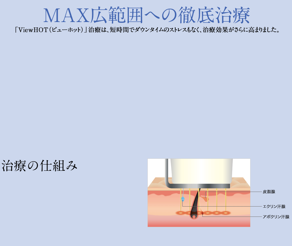 MAX広範囲への徹底治療「ViewHOT(ビューホット)」治療は、短時間でダウンタイムのストレスもなく、治療効果がさらに高まりました。