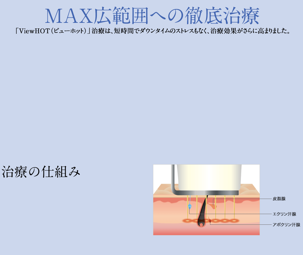 MAX広範囲への徹底治療「ViewHOT（ビューホット）」治療は、短時間でダウンタイムのストレスもなく、治療効果がさらに高まりました。