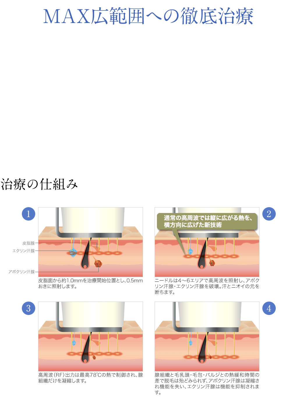 強力な吸引器で汗腺類をしっかり除去/DEC（高周波機器）で確実な効果を実現します/ファイバー・スコープで奥まで確認し、万全を期します